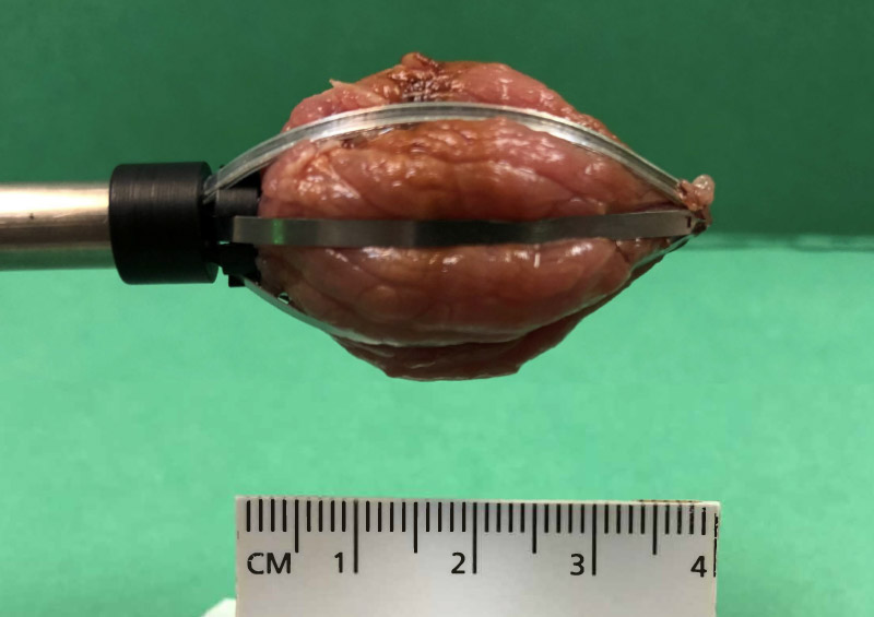 25mm Diameter Tissue Capture Using Wand