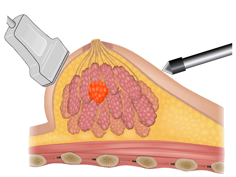 Step 1: Use ultrasound to localize the lesion
