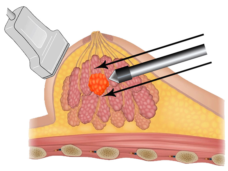 Step 2 Use ultrasound to position wand proximal to lesion