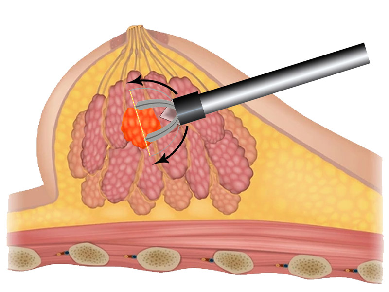 Step 3 Initiate automated capture of lesion