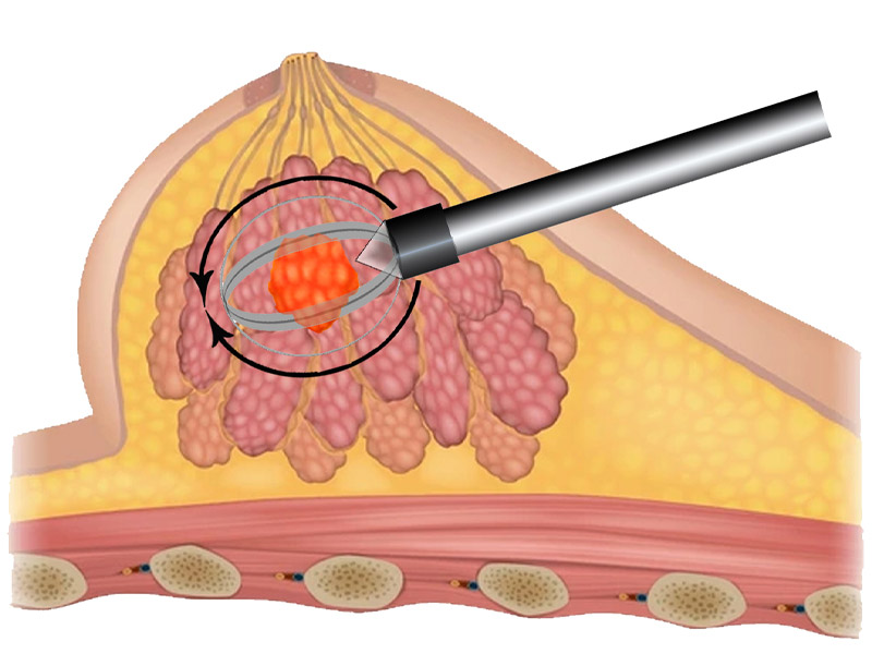 Step 4 Complete automated capture of lesion. 