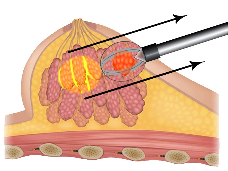 Step 5 Initiate withdrawal of captured lesion