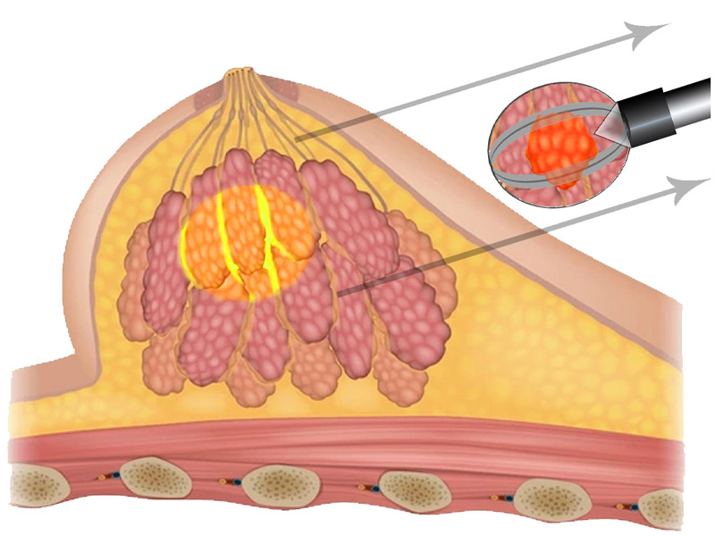 Step 6 Tissue volume containing lesion is submitted for pathology examination. 