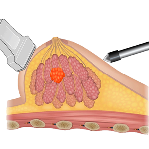 tn-neocision-illustration1 Neocision Illustration 1