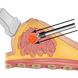 tn-neocision-illustration2 Neocision Illustration 2